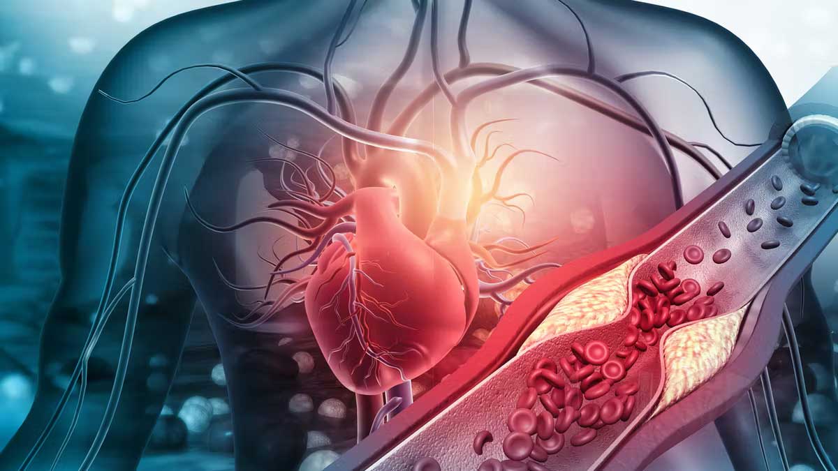 Athérosclérose  tout savoir sur les symptômes et la prévention de cette maladie des artères qui se bouchent