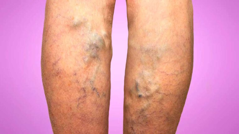 Varices des jambes : quelques symptômes à ne pas négliger