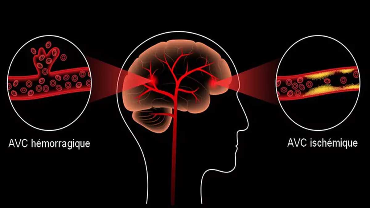 Les symptômes typiques de l'AVC
