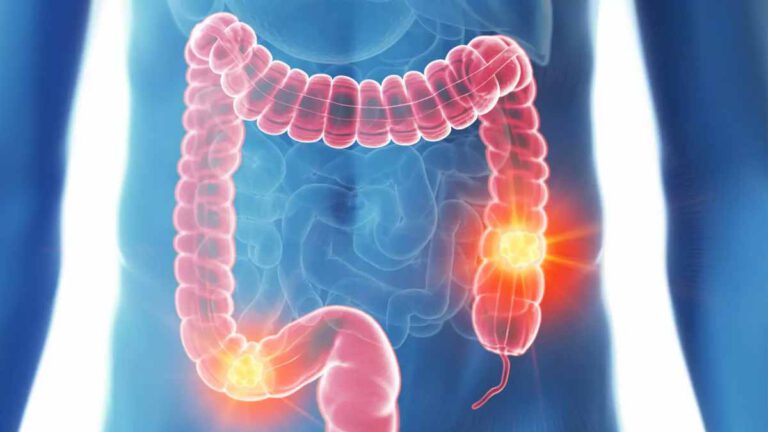 Cancer colorectal voici les 3 premiers symptômes révélateurs de la maladie