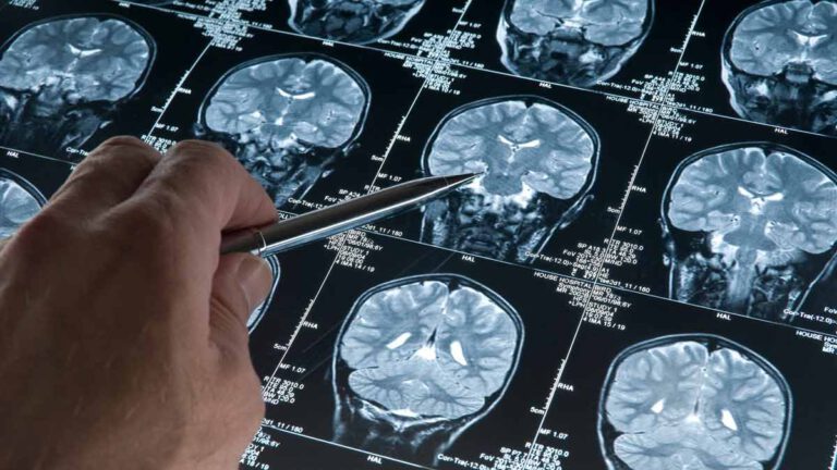 ALERTE Info Alzheimer ce signe précoce va aider dans le diagnostic, avant l’apparition des premiers symptômes