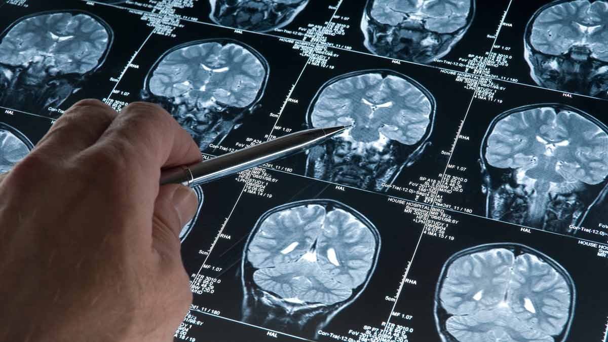 ALERTE Info Alzheimer ce signe précoce va aider dans le diagnostic, avant l’apparition des premiers symptômes