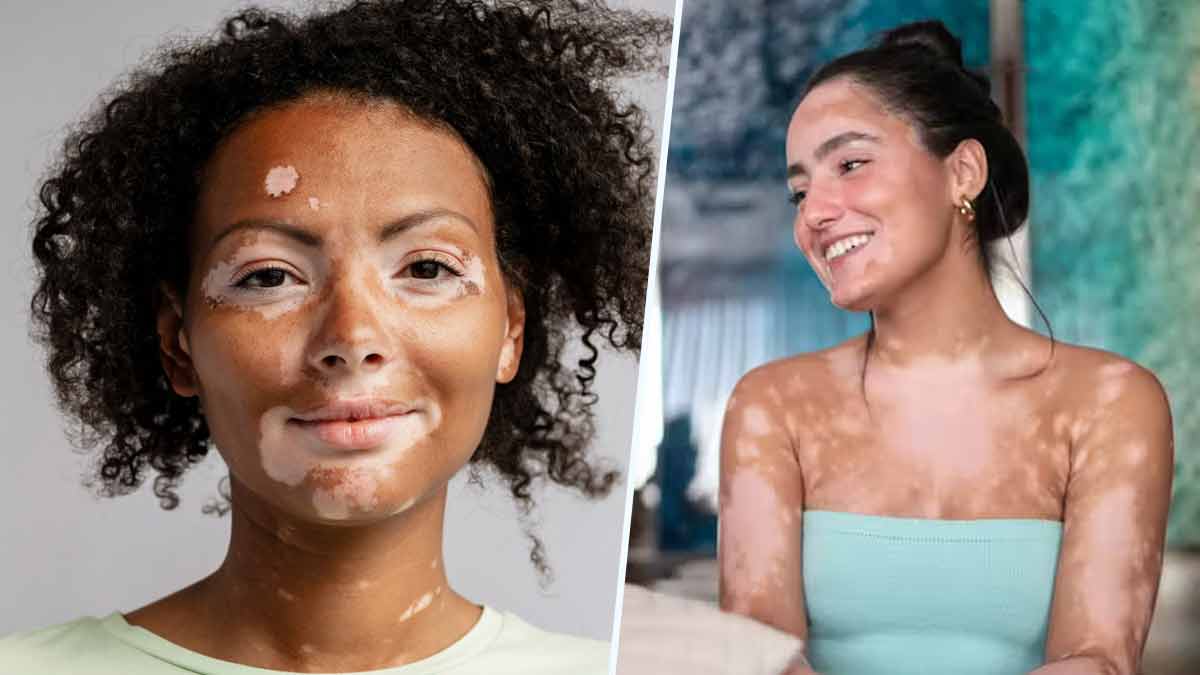 ALERTE Info Vitiligo causes, traitements… voici tous ce qu’il faut savoir sur cette maladie de la peau