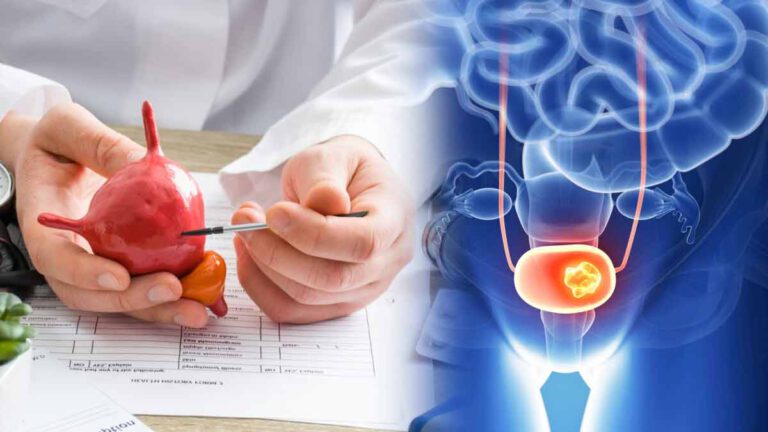 Cancer de la vessie Attention, ce premier symptôme apparaît dans 80 à 90% des cas